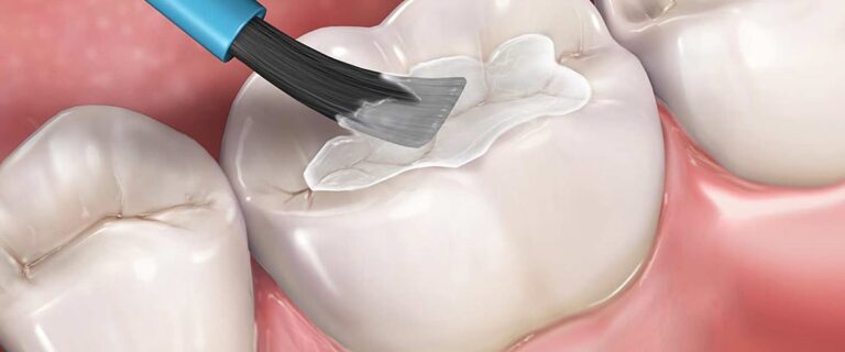 Dental Sealants (Protective Coatings)