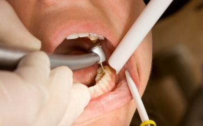 Restorative Dentistry (Cavity Fillings)